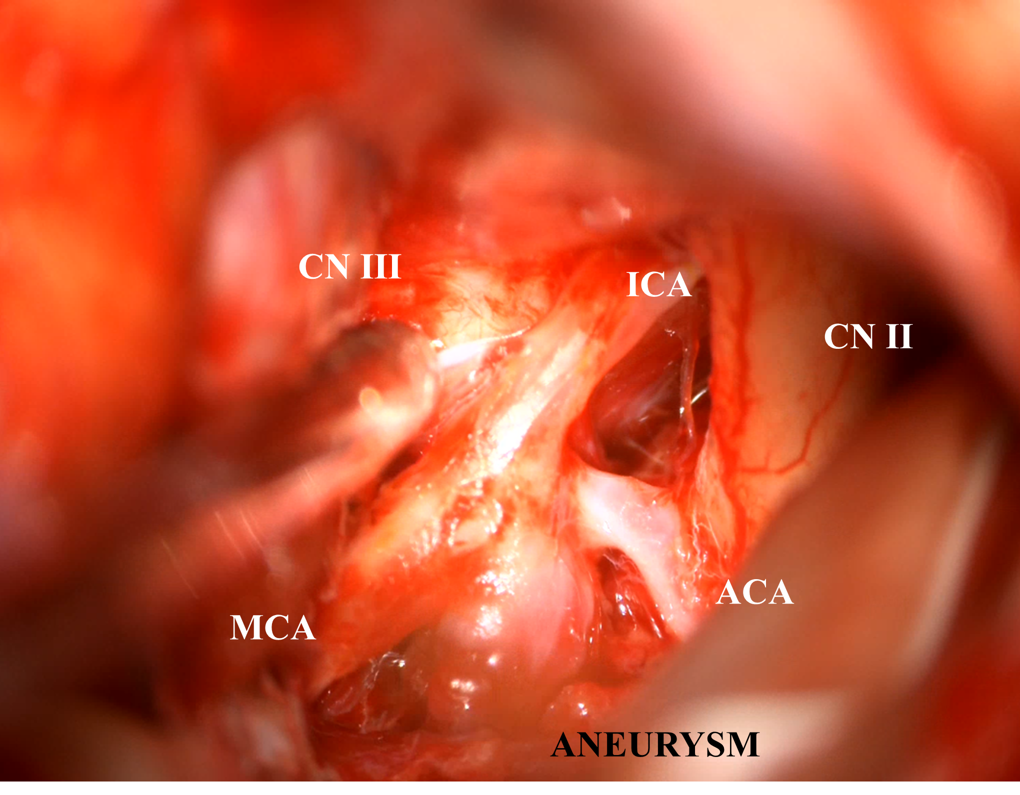 Figure 7. Left pterional craniotomy exposure.]